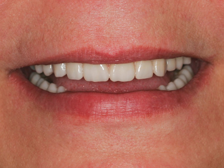 Lippenprofil der Implantatarbeit
